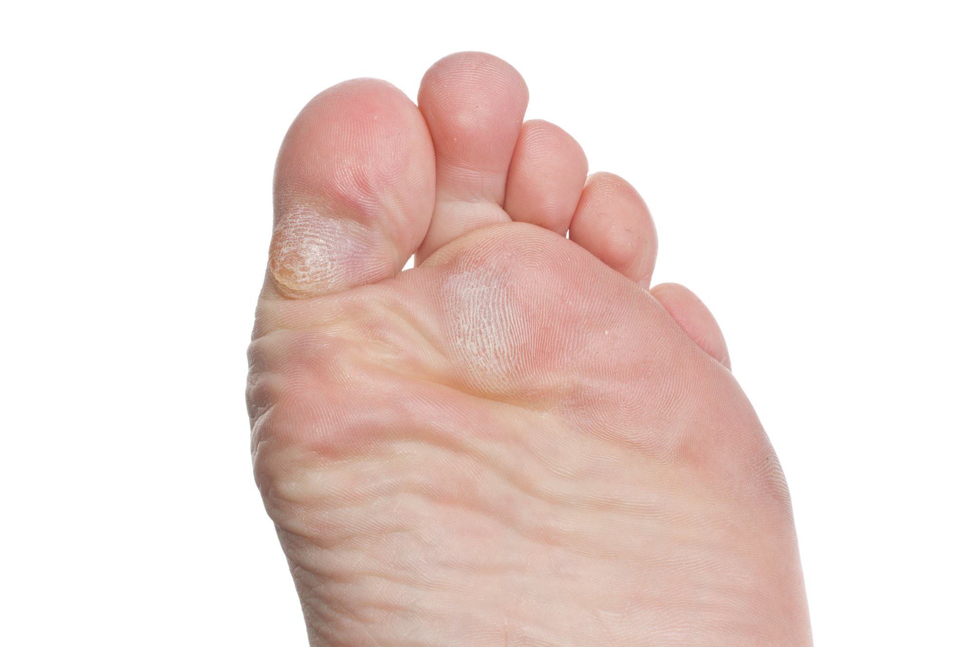 Wat zijn voorkomende voetklachten en voetproblemen?